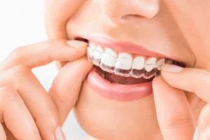 How Do Invisalign Attachments Work?
