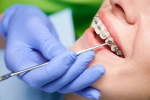 Can You Chew Gum with Braces?