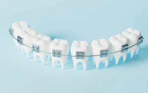 What is Considered Adult Orthodontics?
