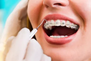 How Do I Floss With Braces?
